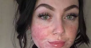 Teacher who nearly quit her job because of severe acne uses social media to  help others