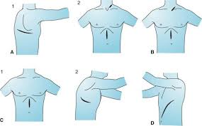 A single incision is made from the chest to the abdomen on the left side, and an incision is made in the neck. Esophageal Cancer Operations Anesthesia Key