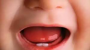Image result for Neonatal Teeth