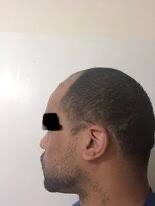 Afro hair type, Norwood 6/7. Looking for a hair transplant surgeon local,  or abroad