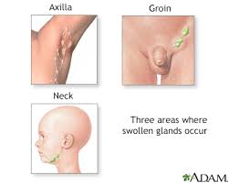 Lymph nodes are small oval clumps of lymphatic tissue found at intervals along the vessels. Swollen Lymph Nodes Information Mount Sinai New York