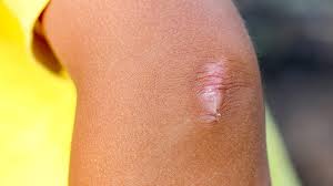 Scar Tissue Pain What It Feels Like Why It Happens And Treatment