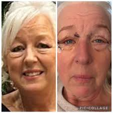 Just over a week I had upper and lower Blepharoplasty uk no pain, however a  lot of tightness eased slightly after the sutures where removed. Still  feeling tired. Swelling more so at