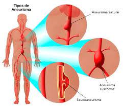 El término aneurisma proviene del vocablo griego anéyrysma y significa dilatación. Aneurisma De Aorta Abdominal Dr Manuel Vallina