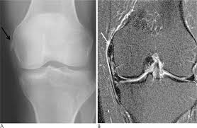 Learn about this soft tissue calcification around the knee joint. Xmlinkhub