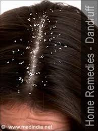 Home Remedies For Dandruff Thick Hair Remedies Dandruff Remedy Hair Remedies For Growth