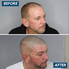 It gets its name from the distinctive sound of the clippers as they cut the hair. Receding Hairline Buzz Cut Balding Before And After Novocom Top