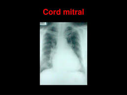 .insuficienta cardiaca insuficienta cardiaca globala sau biventriculara insuficienta coronariana insuficienta hepatica insuficienta mitrala insuficienta ovariana insuficienta pancreatica insuficienta renala insuficienta tricuspida insuficienta venoasa cronica insuficienta ventriculara dreapta. Ppt Suport De Curs Aparatul Cardio Vascular Powerpoint Presentation Free Download Id 6047240