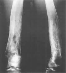 Image result for Osteomyelitis