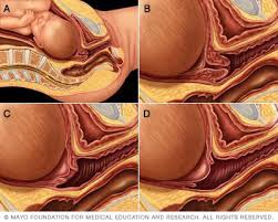 A partir de loc prep locución preposicional: Borramiento Y Dilatacion Del Cuello Del Utero Mayo Clinic