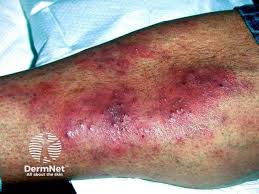 Image result for skin rash acute hiv infection