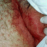 I was a bit embarrassed as it is due to weight. Intertrigo