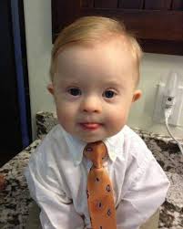 This child, with an extra chromosome, is valuable and worthy of life. Do  you agree?