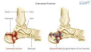 Calcaneus Fracture And Calcaneus Plate