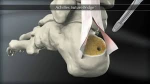 Send it to @deanandphil and i'll answer it on my show!. Haglund S Deformity Treatment And Information Youtube