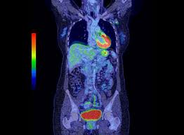 Right now, ct scans aren't routinely used to look for breast cancer, but may be used to look at chest, spine, or abdominal problems, such as a herniated disc or. Pet Macquarie Medical Imaging Macquarie University