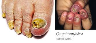 Image result for mykoza nehtů