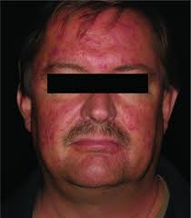 Informative str markers for marfan syndrome in birjand, iran. Pathogenese Und Klinik Der Rosazea Als Schlussel Fur Eine Symptomorientierte Therapie Reinholz 2016 Jddg Journal Der Deutschen Dermatologischen Gesellschaft Wiley Online Library