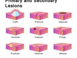 Skin Lesions Chart Primary Skin Nurse Nursing School Dental Hygiene School