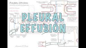Pleural Effusion Detailed Pathophysiology Signs And Symptoms Treatment