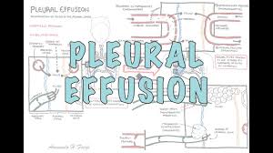 pleural effusion detailed pathophysiology signs and symptoms treatment