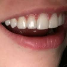 In most cases, the gap in front teeth forms as soon as the permanent teeth erupt in a child. Your Opinion On My Teeth After Braces Is There Anything I Can Do I Think That My Front Teeth Stick Out After Braces Photo