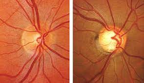 Learn vocabulary, terms and more with flashcards, games and other study tools. Glaucoma Optometrist In Saint James Mn Olson Optical