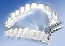 Wann ist eine wurzelkanalbehandlung zum zahnerhalt notwenig und wann sollte man den zahn ziehen und ein implantat machen?wir. Wann Muss Man Einen Zahn Ziehen