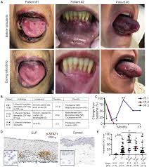 Biopsy from an already scarred area of hair loss is unhelpful. Treatment Of Severe Lichen Planus With The Jak Inhibitor Tofacitinib Journal Of Allergy And Clinical Immunology