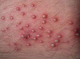They happen most often where there may be rubbing and sweating. Folliculitis Causes Symptoms And Treatment