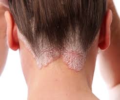 علاج قشرة الشعر الفطرية وأنمائها