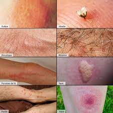 Soigner piqure punaise de lit. Piqures D Insectes Comment Reconnaitre Quel Insecte Vous A Pique