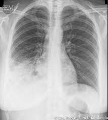 Image result for Pneumonia