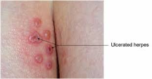 How To Tell Genital Herpes Apart From Other Skin Conditions