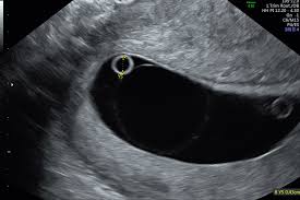 Ce inseamna si care sunt implicatiile pentru pacienti? Embrioreductia I Ce Este I Cand Se Recomanda I Riscuri I Femmeboutiquemedical Com