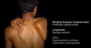 Image result for Winged Scapula