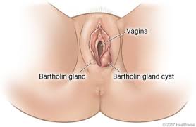 Image result for Bartholin's gland abscess