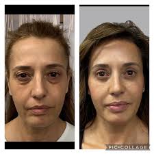 Brow/Forehead Lift Albuquerque NM, D. Eric Tuggle, D.D.S.