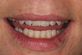 Check spelling or type a new query. Teeth Staining Homegirl Hygienist