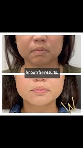 Trust the experts at Wise Aesthetics. , Something bothering you? No  worries! We are here for you and your realistic RESULT!, Correcting volume  loss and providing support is key to a natural result as ...