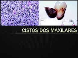 CISTOS DOS MAXILARES OFICIAL - Estomatologia