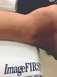 The tendon is named after the ancient greek mythological figure achilles because it lies at the only part of his body that was still vulnerable after his mother had dipped him (holding him by the heel) into. Why Minimally Invasive Repair Is The Best Option For Achilles Tendon Tears Podiatry Today