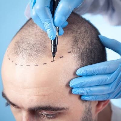 1 Dirham Hair Transplant In UAE | Enfield Royal Clinic