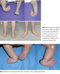 Die übung sollte zusammen mit reflexgymnastik jeden tag 5x5 minuten durchgeführt wer. Fehlbildungen Des Sauglingsfusses Orthopadie Traumatologie Universimed Medizin Im Fokus