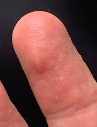 Image result for dyshidrosis