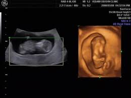 Live beim ultraschall | sie muss wieder kotzen. 3d Ultraschall Wikipedia