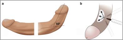 Narrowing or hour glass of the shaft of the penis. Management Of The Acute Phase Of Peyronie S Disease A Contemporary Review Springerlink