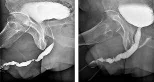 El hipospadias es un defecto de nacimiento en el que la abertura de la uretra se encuentra en la parte inferior del pene en lugar de la punta. Cual Es El Tratamiento De Una Estenosis Uretral En Un Paciente Operado De Hipospadias Consulta Alfredo Gil Vernet
