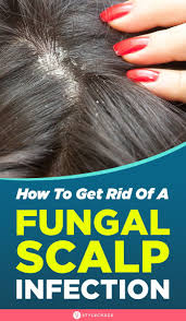 How To Get Rid Of Fungal Scalp Infection 8 Natural Remedies Dry Scalp Treatment Diy Dry Scalp Treatment Scalp Fungus Treatment