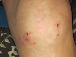 Each knee has two of these rubbery pads of cartilage this care sheet gives you a general idea about how long it will take for you to recover. My Recovery Experience After Arthroscopic Partial Meniscectomy Patient S Lounge